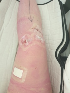 A photo of my leg showing the incision areas
